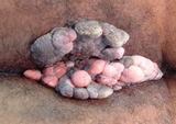 anal wart